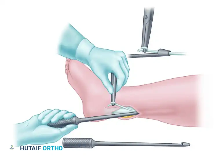 Brand Tendon Stripper