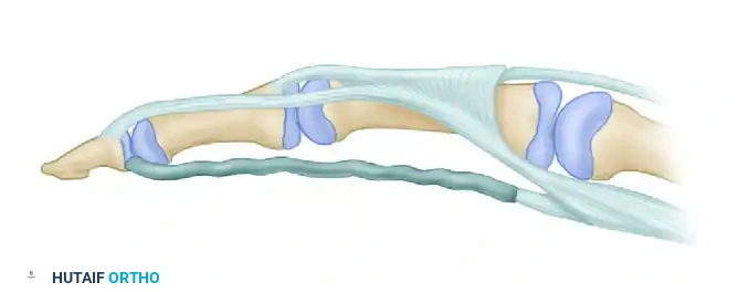 Distal Suture Technique