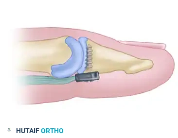 Distal Fixation Preparation