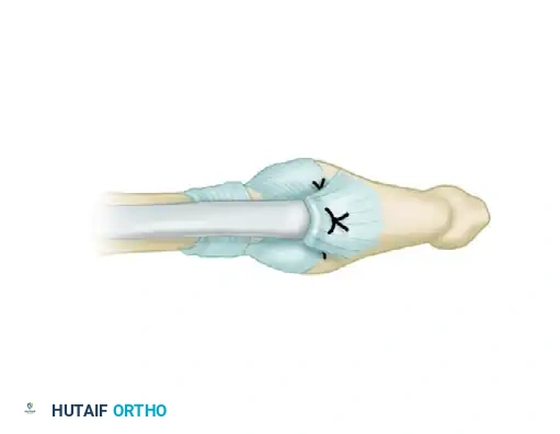 Postoperative Splinting