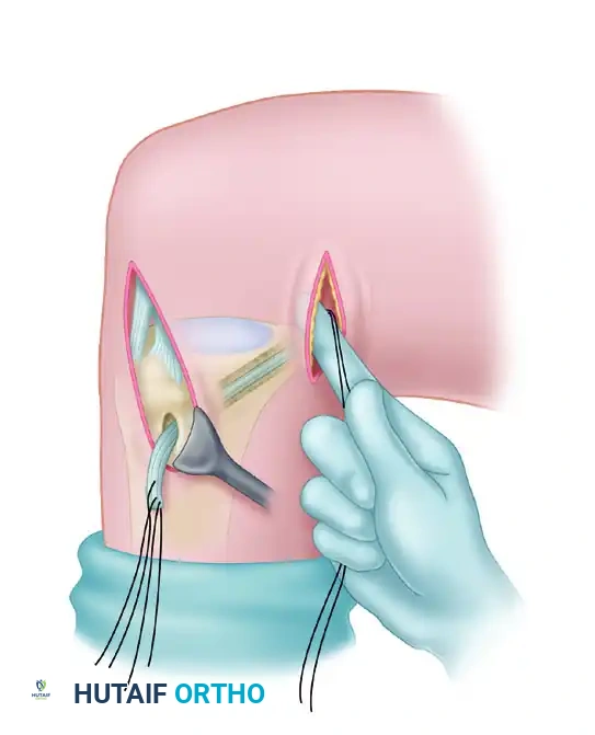 Graft is passed through tibial tunnel from anterior to posterior