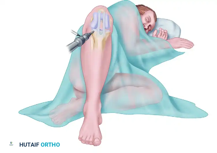 Mastering Posterior Cruciate Ligament Reconstruction: The Tibial Inlay Technique with Bone-Patellar Tendon-Bone or Achilles Tendon-Bone Grafts