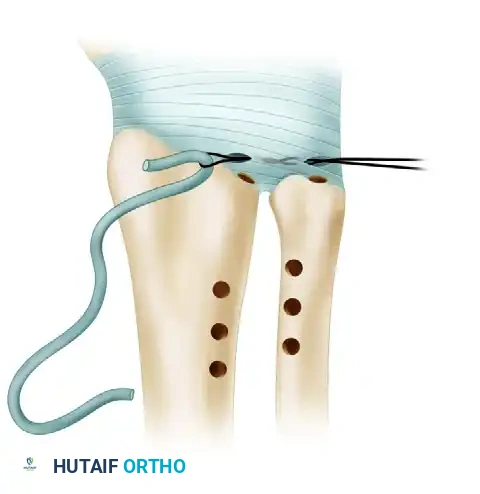 Mastering TFCC Dorsal Ligament Reconstruction and Ulnar Impaction Management
