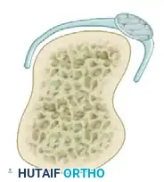 Comprehensive Management of Extensor Mechanism Injuries: Boutonnière Deformity, Zone IV-V Lacerations, and Sagittal Band Ruptures