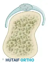 Type II Sagittal Band Injury