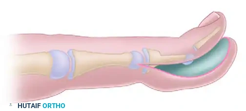 RECONSTRUCTION OF THE HAND AND WRIST Surgical Diagram