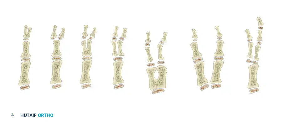 Congenital Hand Reconstruction: Apert Syndrome & Polydactyly