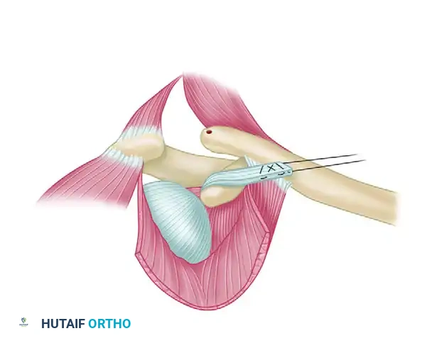 RECONSTRUCTION OF THE SUPERIOR ACROMIOCLAVICULAR LIGAMENT FOR OLD UNREDUCED ACROMIOCLAVICULAR JOINT DISLOCATION Surgical Diagram
