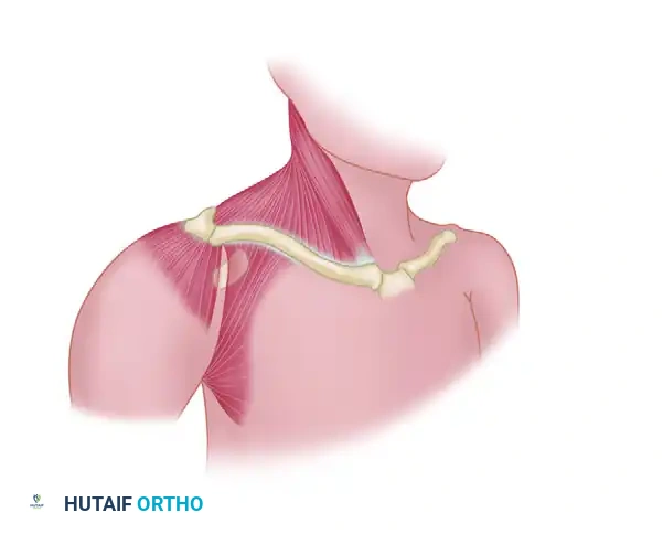 RECONSTRUCTION OF THE SUPERIOR ACROMIOCLAVICULAR LIGAMENT FOR OLD UNREDUCED ACROMIOCLAVICULAR JOINT DISLOCATION Surgical Diagram
