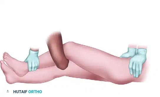 FIGURE 55-59 Stimson maneuver for reduction of hip dislocation.
