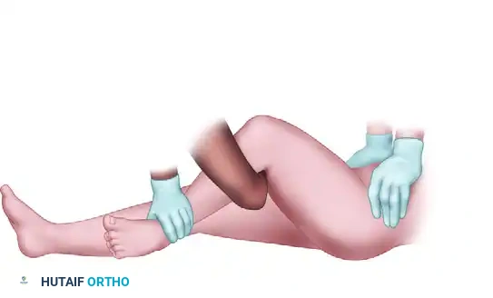 FIGURE 55-59 Stimson maneuver for reduction of hip dislocation.