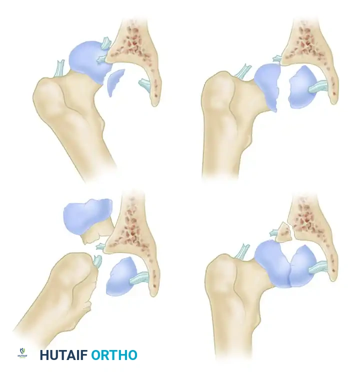 REDUCTION MANEUVER FOR ANTERIOR HIP DISLOCATION Surgical Diagram