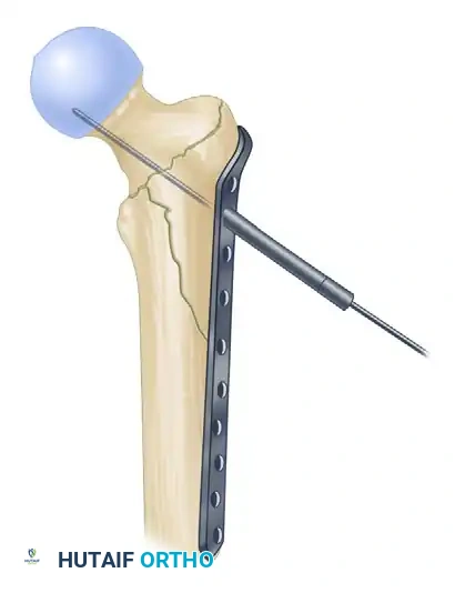REDUCTION MANEUVERS FOR POSTERIOR HIP DISLOCATION Surgical Diagram