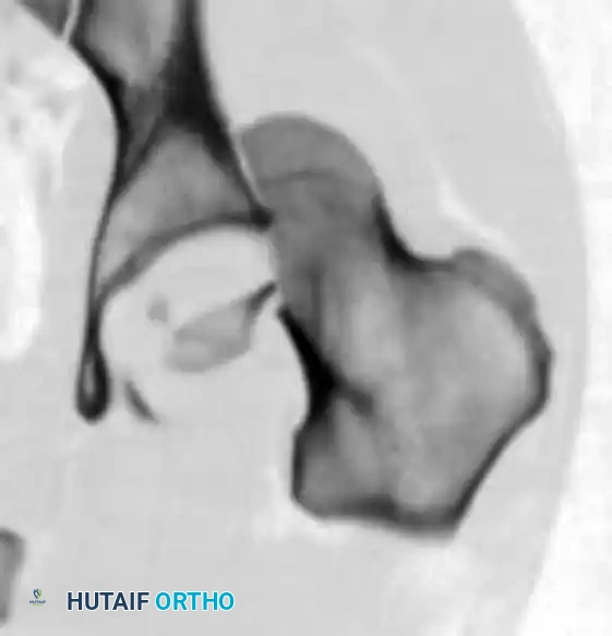 REDUCTION MANEUVERS FOR POSTERIOR HIP DISLOCATION Surgical Diagram