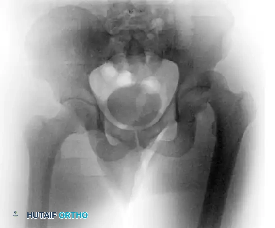 REDUCTION MANEUVERS FOR POSTERIOR HIP DISLOCATION Surgical Diagram