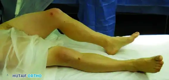 Posterior Hip Dislocation: Comprehensive Closed Reduction Maneuvers and Management