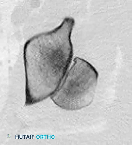 REDUCTION MANEUVERS FOR POSTERIOR HIP DISLOCATION Surgical Diagram