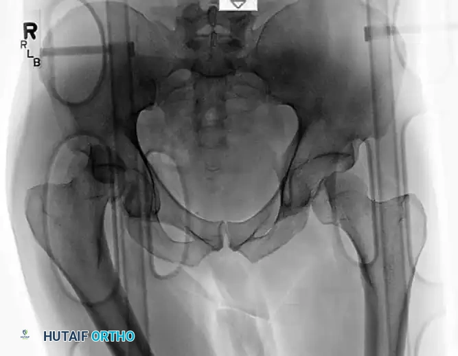 REDUCTION MANEUVERS FOR POSTERIOR HIP DISLOCATION Surgical Diagram
