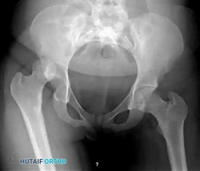 FIGURE 55-54 Incongruous joint after closed reduction due to intraarticular fragments. A, Pre-reduction radiograph. B, Radiograph after reduction. Axial (C) and coronal (D) CT scans after reduction.