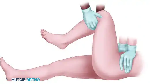 FIGURE 55-57 Allis reduction maneuver for posterior hip dislocation.