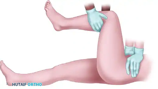 FIGURE 55-57 Allis reduction maneuver for posterior hip dislocation.