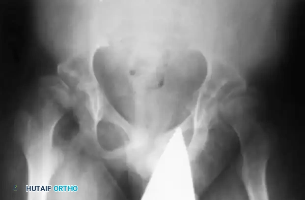 Fig. 32-25 Coxa valga deformity and subluxation in 12year-old child with spinal muscular atrophy.