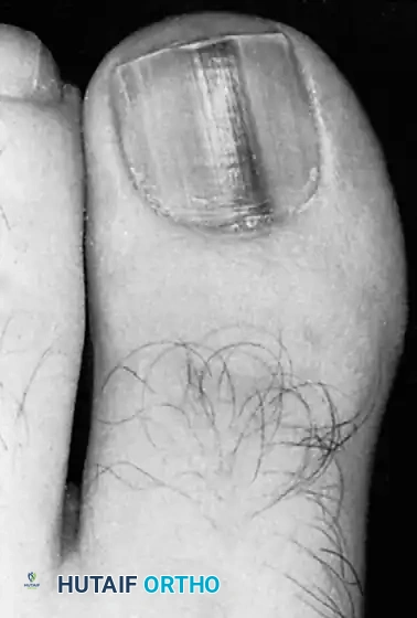 Fig. 84-31 Hutchinson sign. Band of pigmented tissue associated with subungual melanoma.