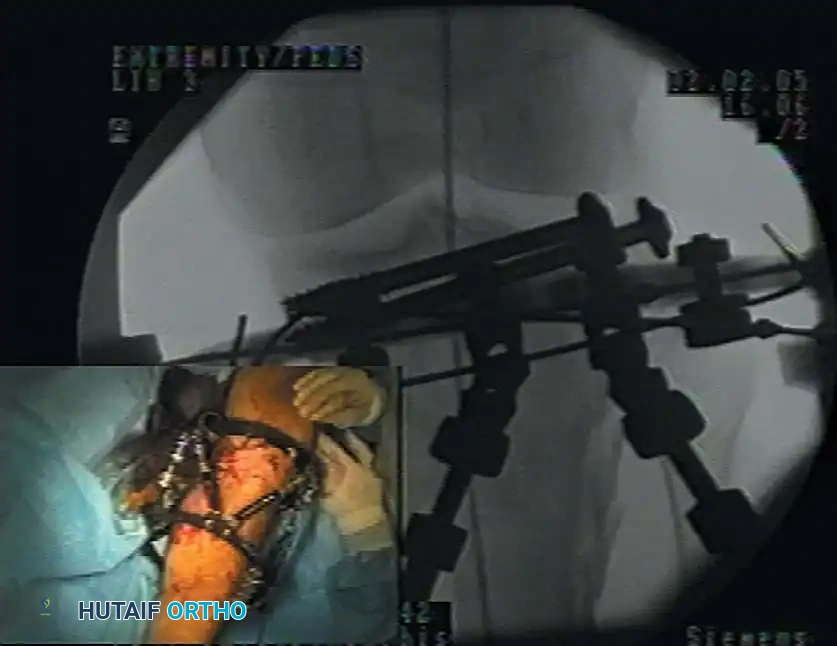 Mastering Postoperative Rehabilitation and Complication Management in Orthopaedic Trauma