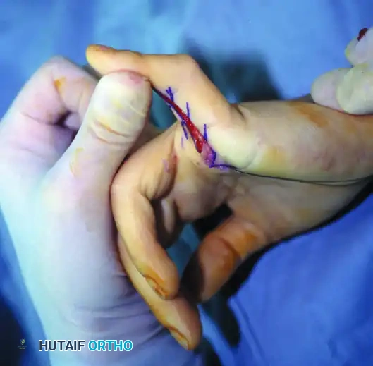 Camptodactyly Wrist Extension