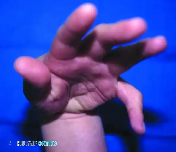 Postoperative Rehabilitation