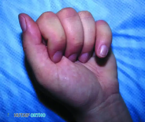 Post Superficialis Tenotomy