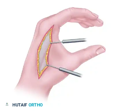 RELEASE OF ESTABLISHED INTRINSIC MUSCLE CONTRACTURES OF THE HAND Surgical Diagram
