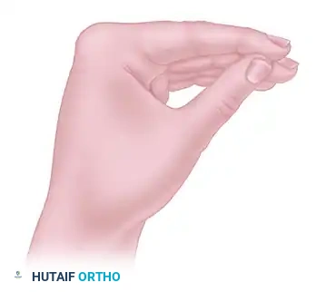 RELEASE OF ESTABLISHED INTRINSIC MUSCLE CONTRACTURES OF THE HAND Surgical Diagram