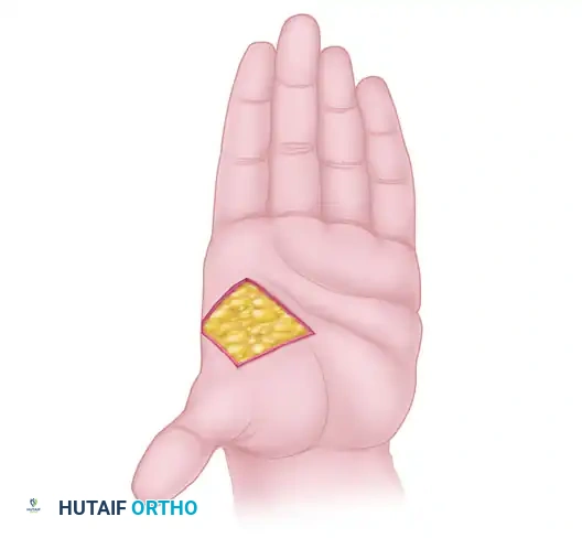 Comprehensive Management of Severe Intrinsic Contractures and Dupuytren Disease