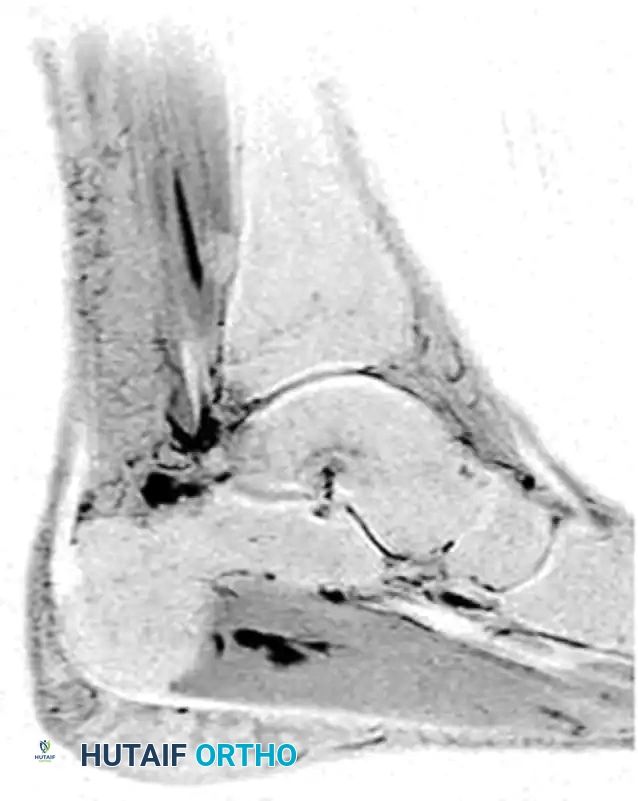 MRI of patient with flexor hallicus longus tendinitis with os trigoneum