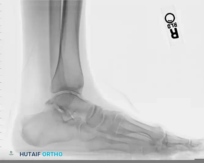 Radiograph of patient with flexor hallicus longus tendinitis with os trigoneum