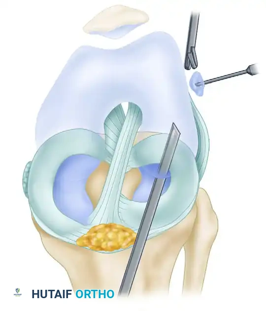 Arthroscopic Management of Knee Loose Bodies, Plicae, and Osteochondritis Dissecans