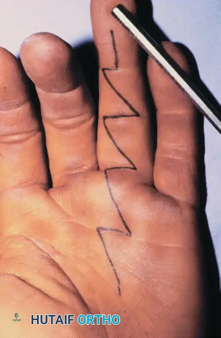 Masterclass in Flexor Tendon Repair: Zones I and II Surgical Techniques