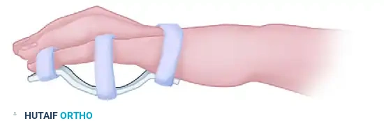 REPAIR IN ZONES III, IV, AND V Surgical Diagram