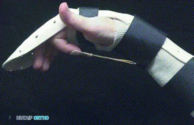 REPAIR IN ZONES III, IV, AND V Surgical Diagram