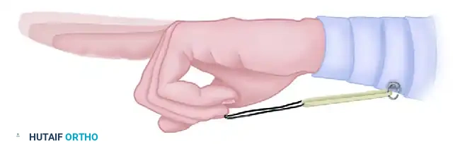 REPAIR IN ZONES III, IV, AND V Surgical Diagram