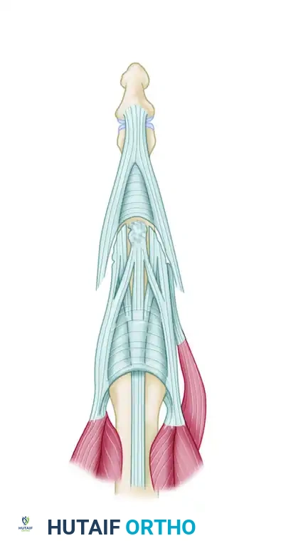 REPAIR OF CENTRAL SLIP OF THE EXTENSOR EXPANSION CAUSING BUTTONHOLE DEFORMITY Surgical Diagram