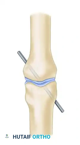 REPAIR OF CENTRAL SLIP OF THE EXTENSOR EXPANSION CAUSING BUTTONHOLE DEFORMITY Surgical Diagram