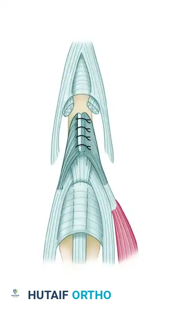 REPAIR OF CENTRAL SLIP OF THE EXTENSOR EXPANSION CAUSING BUTTONHOLE DEFORMITY Surgical Diagram