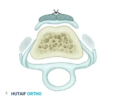 REPAIR OF CENTRAL SLIP OF THE EXTENSOR EXPANSION CAUSING BUTTONHOLE DEFORMITY Surgical Diagram