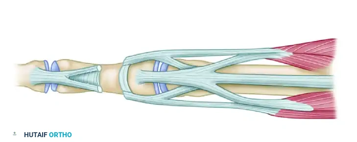 REPAIR OF CENTRAL SLIP OF THE EXTENSOR EXPANSION CAUSING BUTTONHOLE DEFORMITY Surgical Diagram
