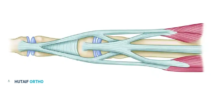 REPAIR OF CENTRAL SLIP OF THE EXTENSOR EXPANSION CAUSING BUTTONHOLE DEFORMITY Surgical Diagram