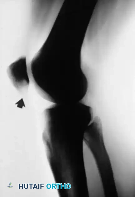 الدليل الشامل لعلاج التهاب وتمزق الوتر الرضفي في الركبة