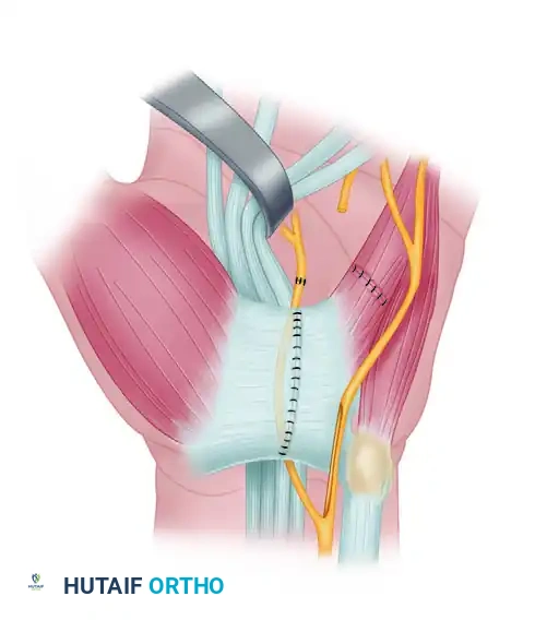 Operative Repair of the Deep Branch of the Ulnar Nerve