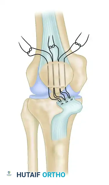 REPAIR WITH SUTURE THROUGH PATELLAR DRILL HOLES Surgical Diagram